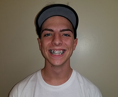teeth-smile-after