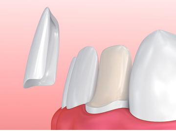 Common Myths and Facts About Dental Veneers