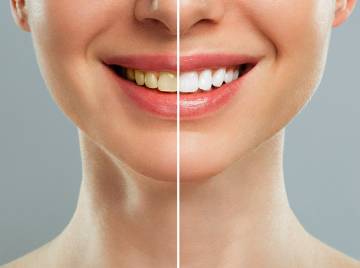 The Benefits of Teeth Whitening