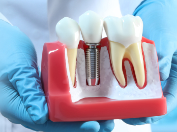 Where to Get Dental Implants in Peoria