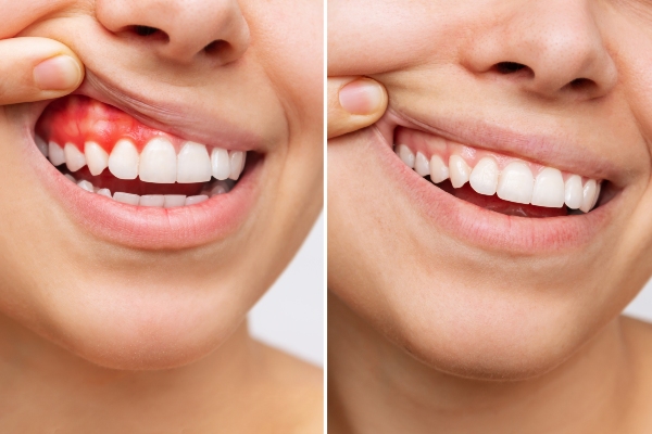 Gum Disease Treatment: What You Need To Know